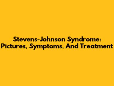 Stevens-Johnson Syndrome: Pictures, Symptoms, And Treatment
